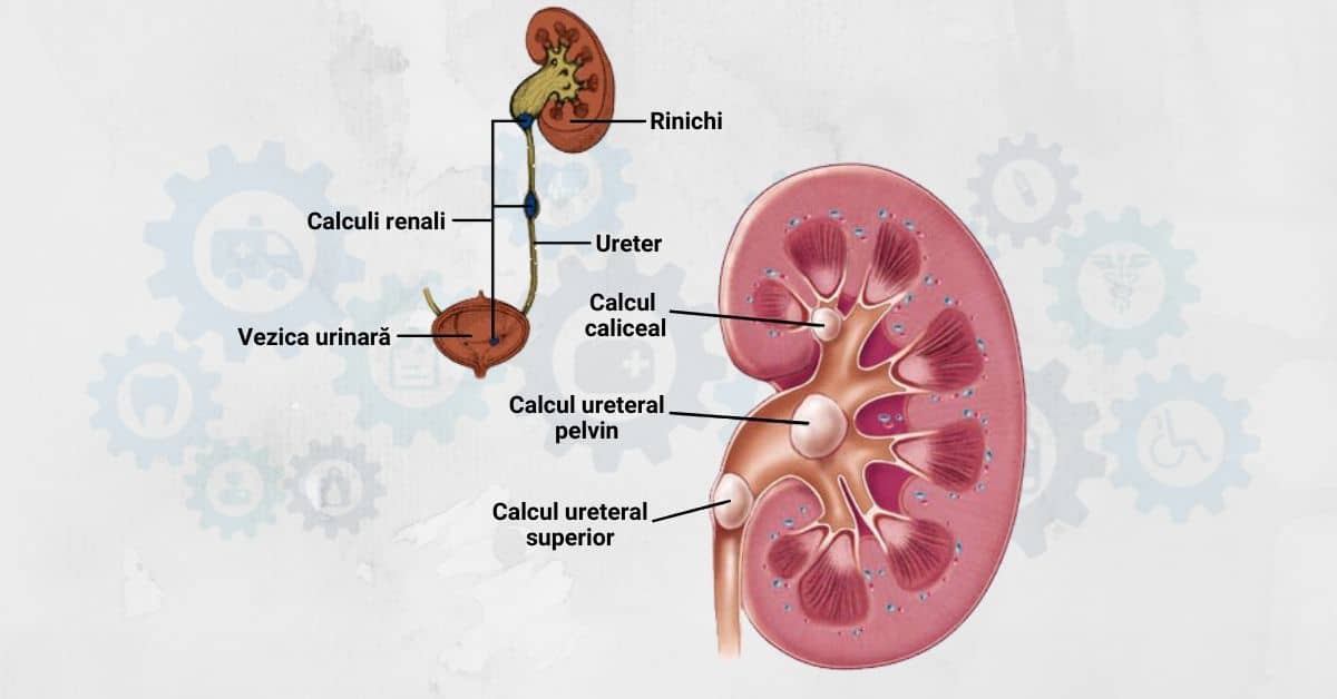 Pietre la rinichi sau colica renala | Medimfarm